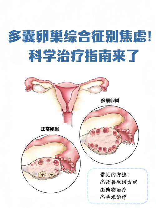 多囊卵巢综合症注意事项 治疗多囊卵巢综合征的药物有哪些 多囊卵巢综合症注意事项 治疗多囊卵巢综合征的药物有哪些