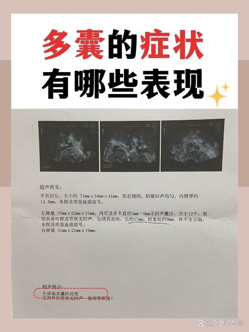 多囊卵巢综合征的治疗和怀孕几率 多囊卵巢综合征的治疗和怀孕几率