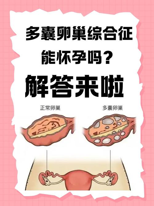 多囊卵巢综合征怎么检查 多囊卵巢综合征怎么检查