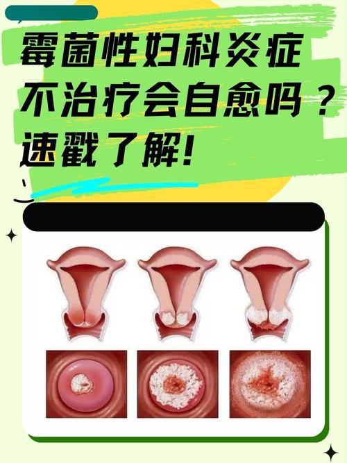 女性妇科疾病有哪些 女性妇科疾病有哪些