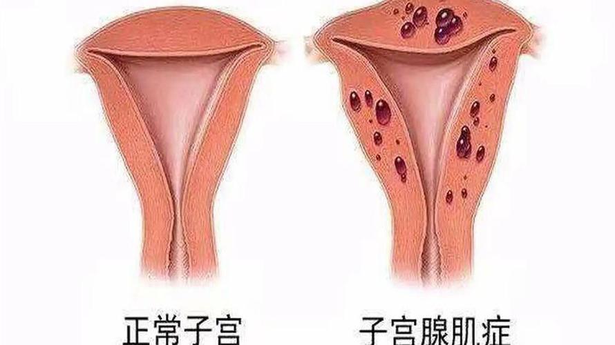 子宫腺肌症是什么病严重吗 子宫腺肌症是什么病严重吗