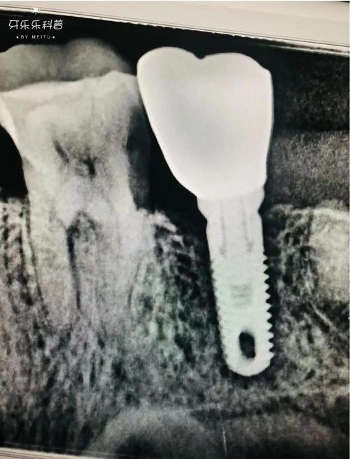 试管婴儿反复种植失败的原因及应对措施 试管婴儿反复种植失败的原因及应对措施