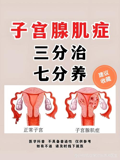 子宫腺肌症的典型症状是什么如何处理 子宫腺肌症的典型症状是什么如何处理